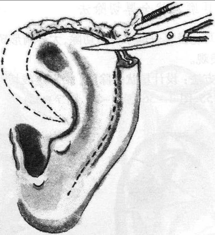 二、耳廓上缘缺损直接缝合法